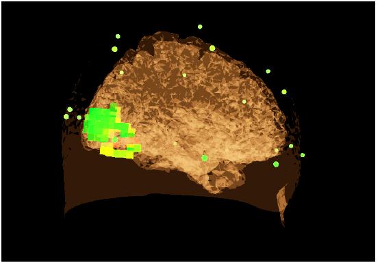 Live sLORETA-basierte Abbildung einer Gehirnaktivität im Okzipitallappen.